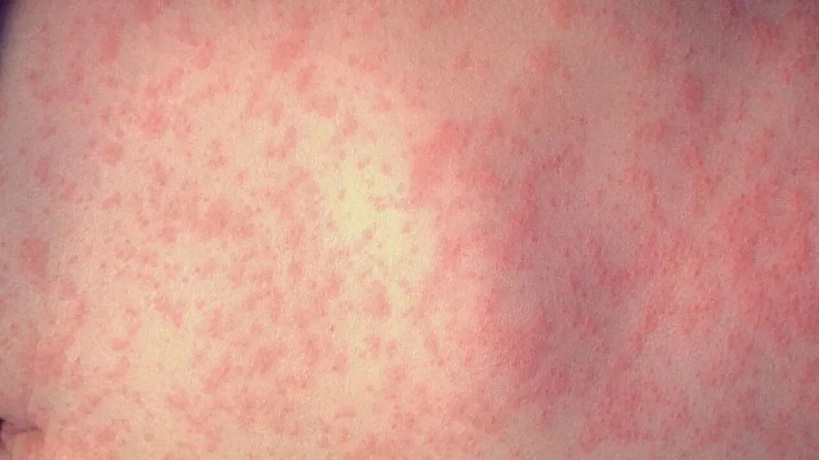 Oregon Health Officials Warn of New Measles Exposure Sites